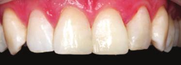 Prior to the application of the buccal enamel layer consisting of highly translucent composite, some pigments were added for characterization.