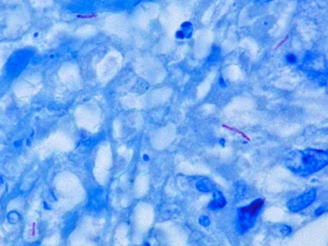 MYCOBACTERIA SPP. Reservoir Clinical Manifestation Mycobacterium tuberculosis Human Pulmonary and dissem. T.B. M. lepra Human Leprosy M. bovis Human & cattle T.B. like infection M.