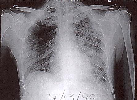 Chest X-Ray of Patient