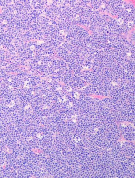 B cell lymphoma, unclassified,