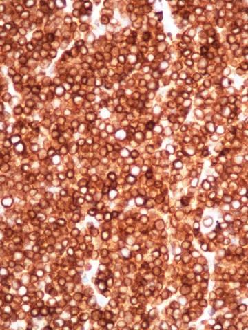 Immunophenotype T cell markers: CD3 (usually cytoplasmic) Polyclonal CD3 antibody is not T cell specific (detects zeta chain) CD4, CD8 frequently