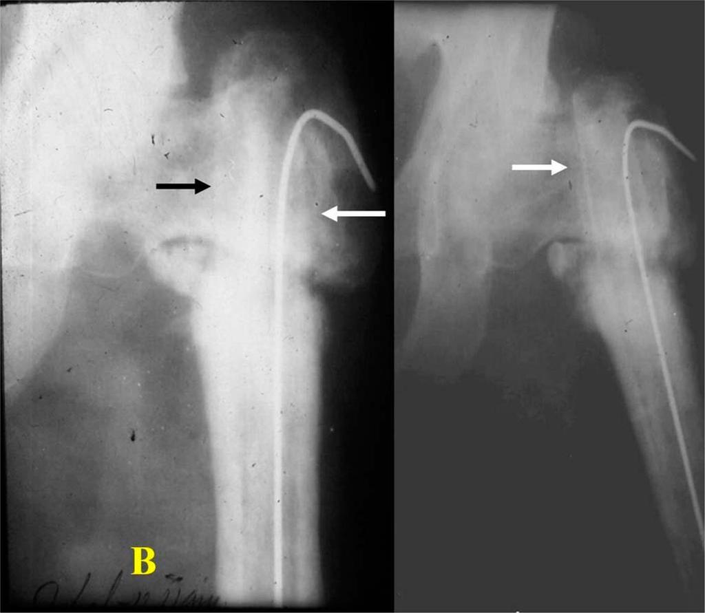 1-A Anteroposterior radiographs showing a subtrochanteric nonunion after 4 surgical procedures, including 2