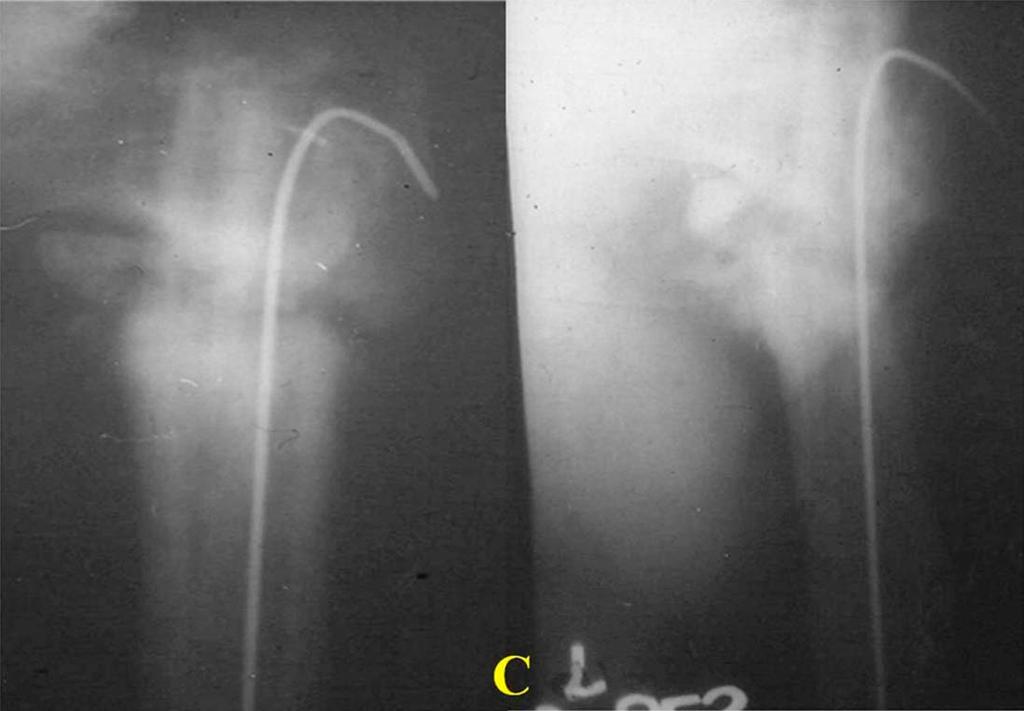 1-B Anteroposterior radiographs made 3 weeks after treatment with a fibular graft, showing signs of healing.