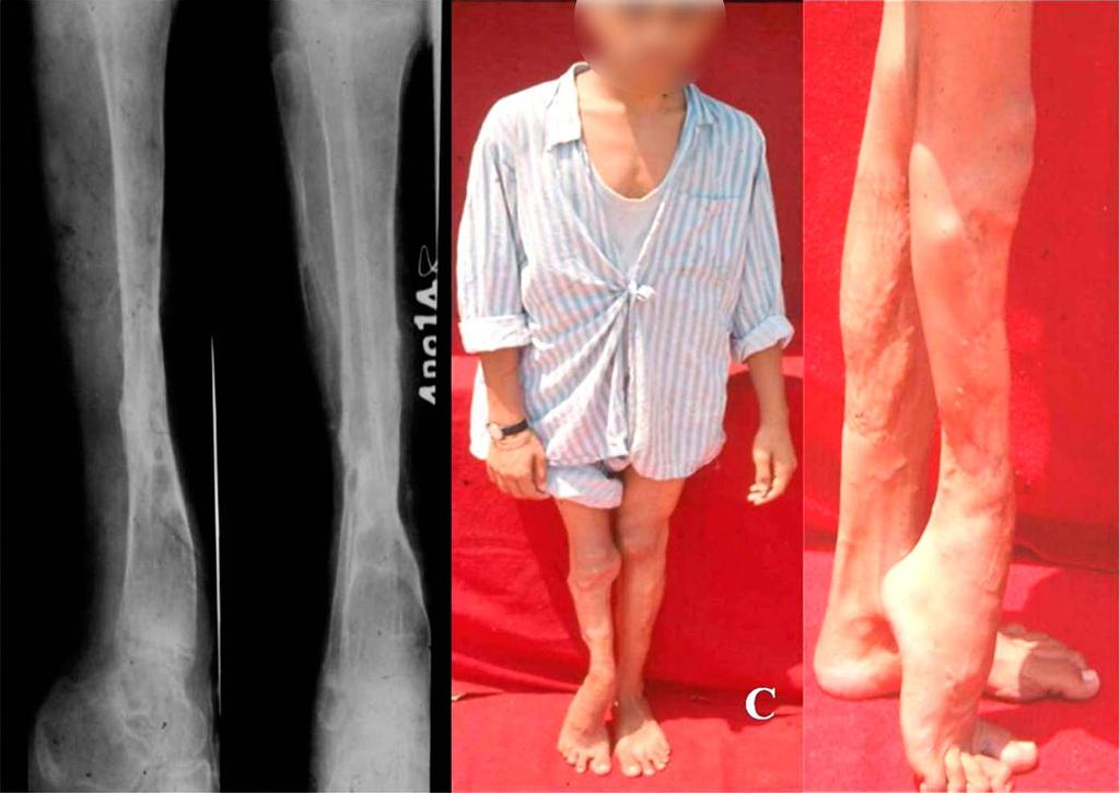 JBJS Open Access d 2018:e0050. openaccess.jbjs.org 4 Fig. 2-C Anteroposterior and lateral radiographs (left) and clinical photographs (right), made 18 months after the insertion of the fibular strut.