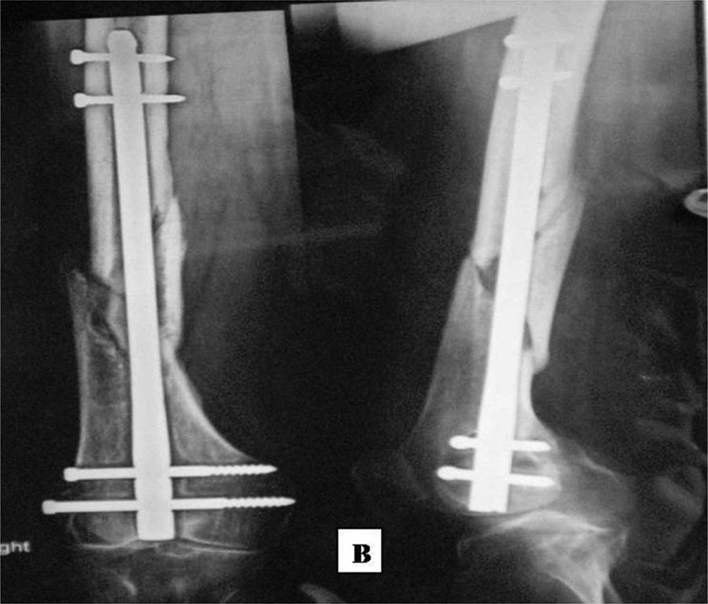 Following procedures involving the femur or tibia, the extremity is supported with use of a Thomas splint. Following procedures involving the humerus, the arm is initially supported with a U-cast.