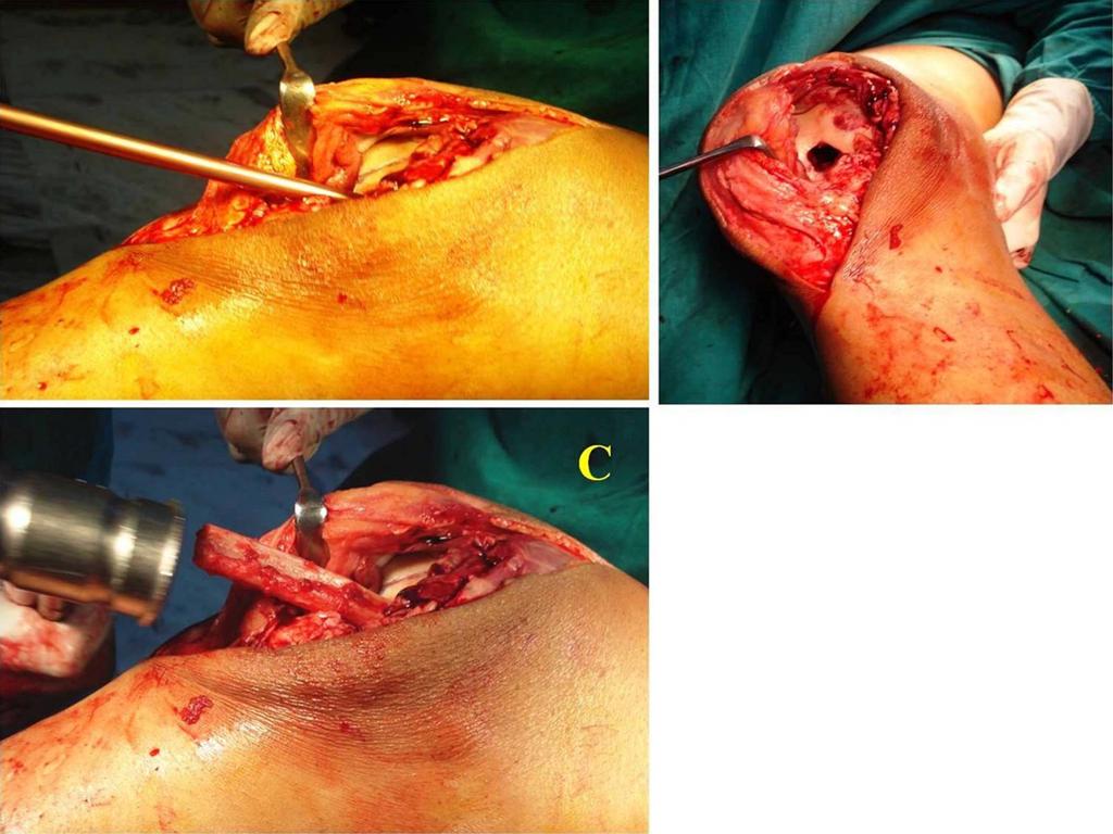 JBJS Open Access d 2018:e0050. openaccess.jbjs.org 5 Fig. 3-C Intraoperative photographs showing the host site and insertion of the strut graft. the greater trochanter.
