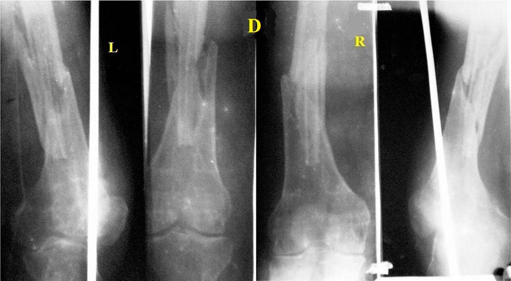 JBJS Open Access d 2018:e0050. openaccess.jbjs.org 6 Fig. 3-D Fig. 3-E Fig. 3-D and Fig. 3-E Radiographs made 10 weeks after placement of the fibular struts at the fracture site.