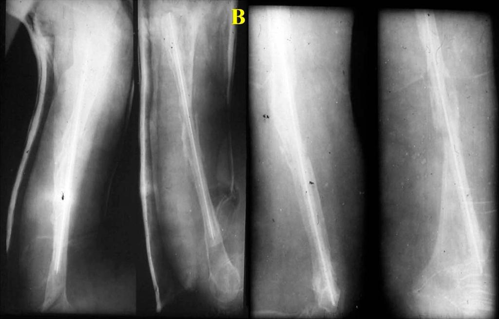 The radiographs show a loose Kuntscher nail and gross osteoporosis. Fig.