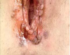 Prevalence of HPV in Genital Warts >90% of cases of genital warts are