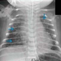 Full term neonate with tachypnea after being delivered via C section. Follow up radiograph obtained 2 days later.