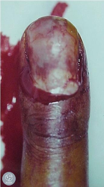 distal phalanx fracture Proximal nail