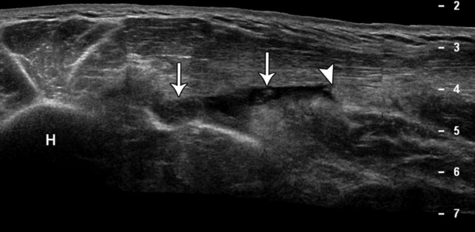 junction, which could potentially cause misdiagnosis of distal tendon avulsions and tears as musculotendinous injuries. In only 1 case was a fluid collection seen medial to the biceps brachii tendon.