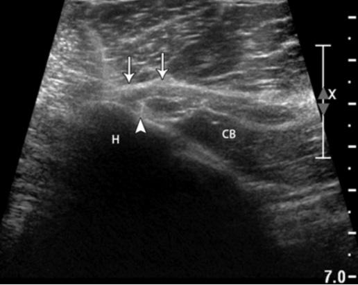 This finding in the setting of a distal and retracted tear may be from collapsed tissue planes, fibrosis, scarring, and possible periosteal stripping.