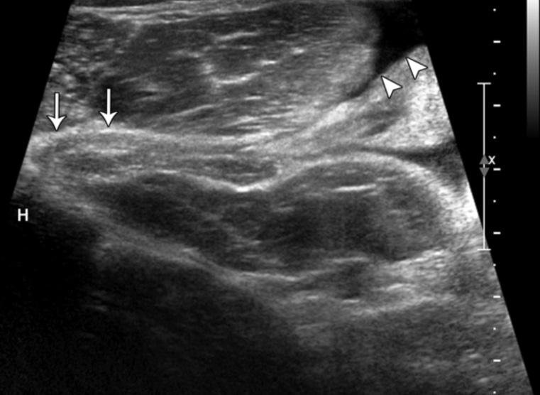 4 In 33% (3 of 9), a normal distal pectoralis tendon was seen attaching to the humerus.