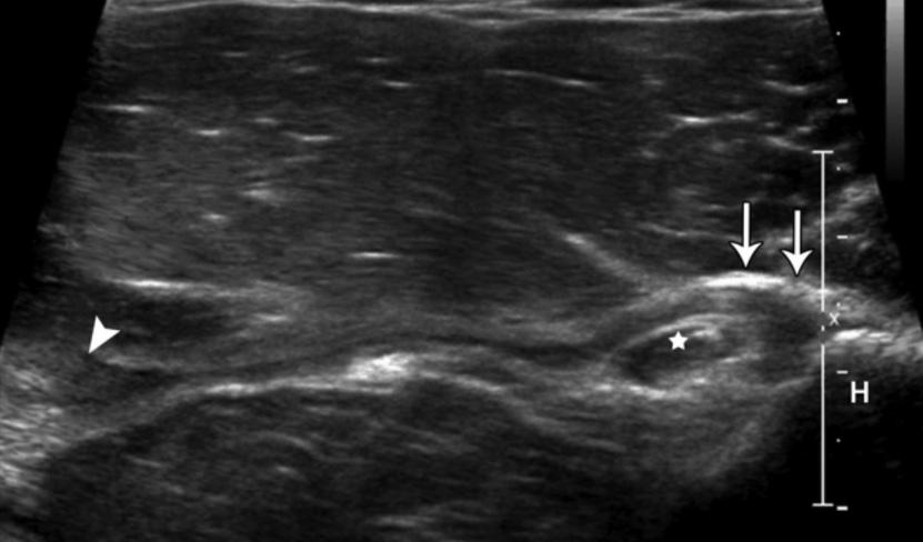 Figure 4. Image from a 40-year-old man with an isolated distal tear of the sternal head of the pectoralis major due to bench-pressing.