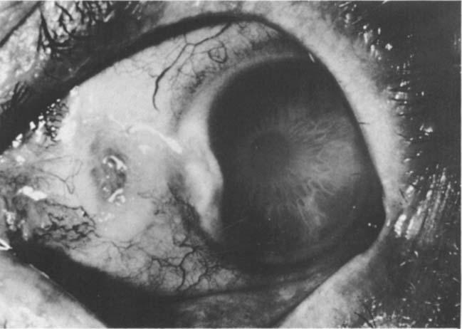 Figirre I: A typical scleral ulcer.