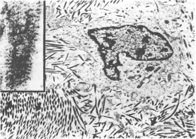 Figure 3: Electronmicrograph of human scleral ulceration.