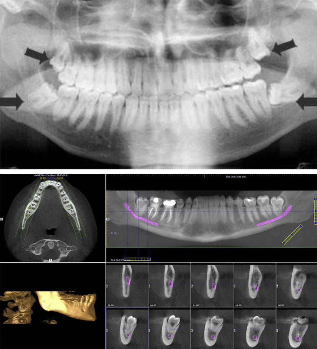 CLINICAL EXAMINATION AND IMAGING TECHNIQUES 165 Fig. 1. (Upper) 2-D orthopantomogram demonstrating wisdom teeth.