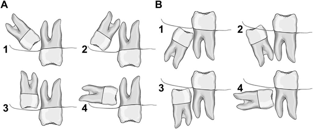 CLINICAL EXAMINATION AND IMAGING TECHNIQUES 167 Table 1 Pederson s difficulty index for impacted mandibular third molar removal as a composite of angulation, depth of impaction, and ramus