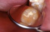 ) The study demonstrated that KETAC MOLAR for ART very effectively helps in treating existing cases of caries and reducing the occurrence of caries when used as a sealant.