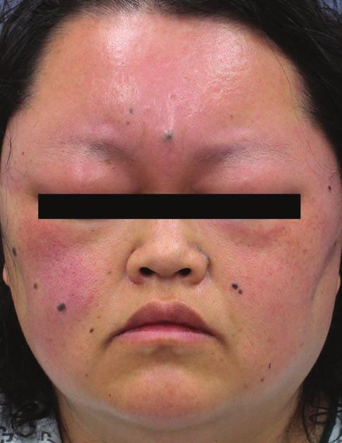 Sweet syndrome with facial swelling 129 Case report A 43-year-old woman presented with a painful erythematous patch with marked swelling on the face.