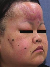 Sweet syndrome with facial swelling 131 focal fluid collection on the forehead, but there was no evidence of haematological malignancy on laboratory evaluation.
