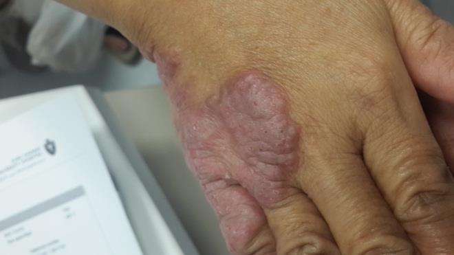 She presented with a history of localized raised erythematous slightly scaly plaque on the lateral and dorsal aspect of the right hand (dominant hand).