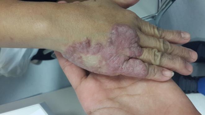 Corticosteroids (ILCS). The patient showed no improvement but the treatment resulted in atrophy of the surrounding skin.