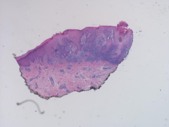 A 4 mm skin punch biopsy was sent to histopathology; the sample was taken from the infected area on the right hand.