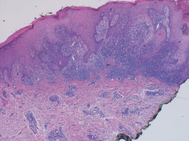 Figure 5: Dense Inflammatory Cell Infiltrate in the Upper Dermis Consisting of Lymphocytic Histiocytes and Polymorphs with a Tendency to Form Non-Caseating Granulomas