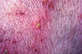 29) Bleeding from cutaneous blood vessels resulting in reddening of the skin which is not blanched by pressure as distinct from inflammatory erythema.