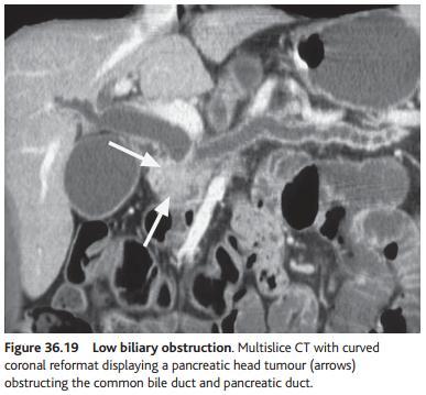 resectability and biliary decompression options.