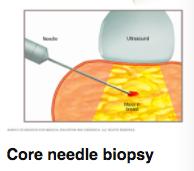 NEEDLE BIOPSY Overview A needle biopsy is a procedure to obtain a sample of cells from your body for laboratory testing.