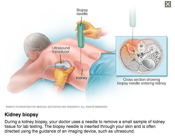 What you can expect During the needle biopsy Your health care team will position you in a way that makes it easy for the doctor to access the area where the needle will be inserted.