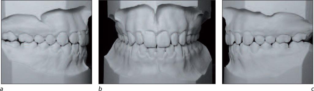 REGARDING MORPHOLOGICAL DIFFERENCES OF THE MAXILLARY ANTERIOR TEETH OF MONOZYGOTIC TWIN SISTERS Figures 16a to 16c T.2.