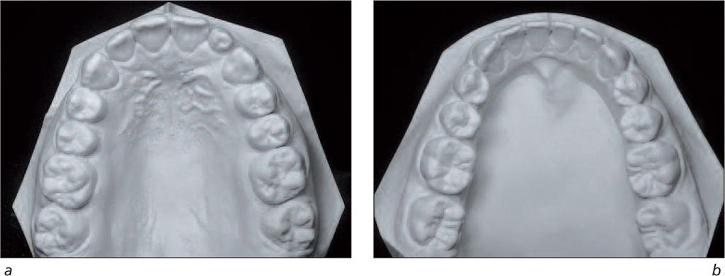 Casts upper and lower occlusal views, 02/04 (13y 11m). Figures 18a and 18b T.2. End of treatment.