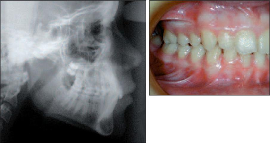 5 mm, HFA 65) whereas 3 DENTAL MEASUREMENT AND INDICES As for dentition, T.1 has two lateral incisors that look unsightly since they are peg-shaped, with both a short root and crown, whereas T.