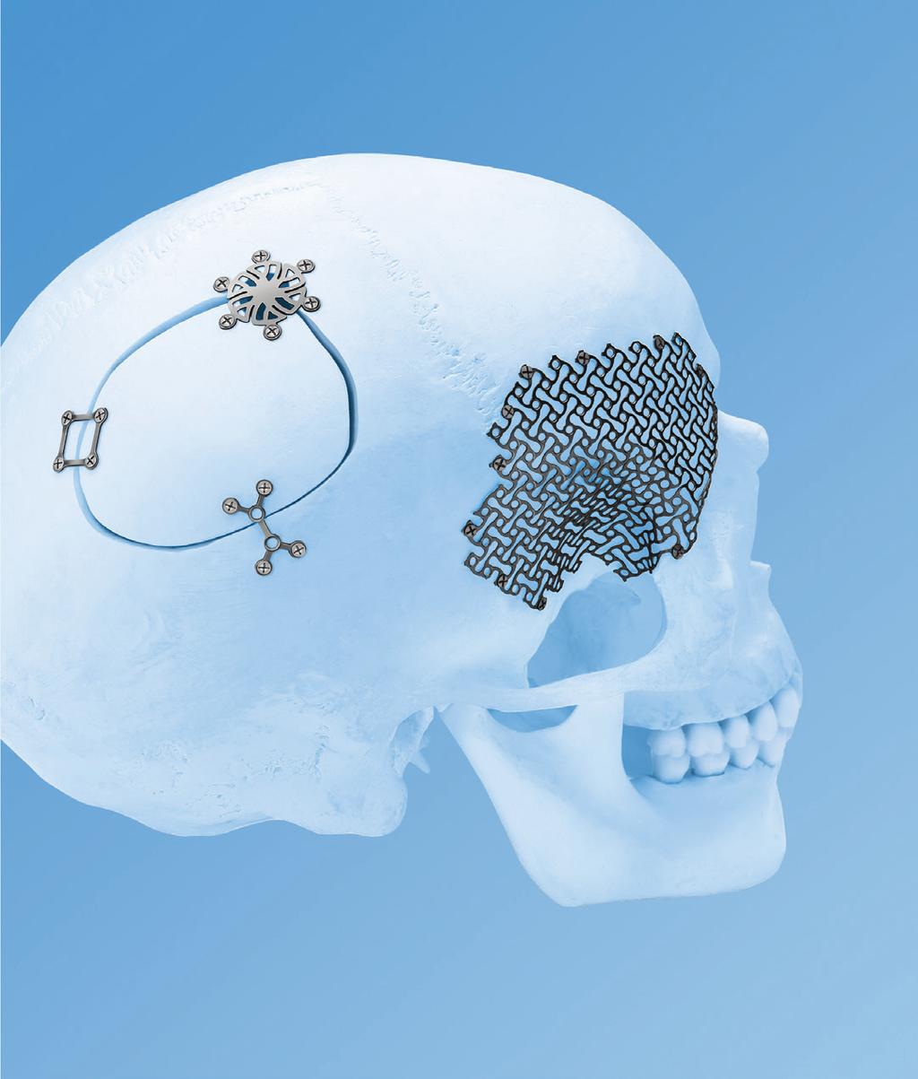 LOW PROFILE NEURO PLATING SYSTEM Introduction The aim of surgical fracture treatment is to reconstruct the bony anatomy and restore its function.