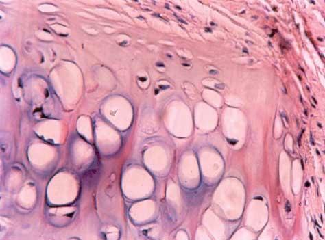 Figure 3. A photomicrograph of crushed, fresh autologous cartilage shows nonviable chondrocytes in the center and an area of chondrogenesis in the periphery (hematoxylin-eosin, original Figure 5.