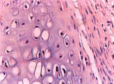 A photomicrograph of noncrushed, preserved autologous cartilage shows nonviable chondrocytes in the center and an area of chondrogenesis in the periphery (hematoxylin-eosin, original Figure 6.