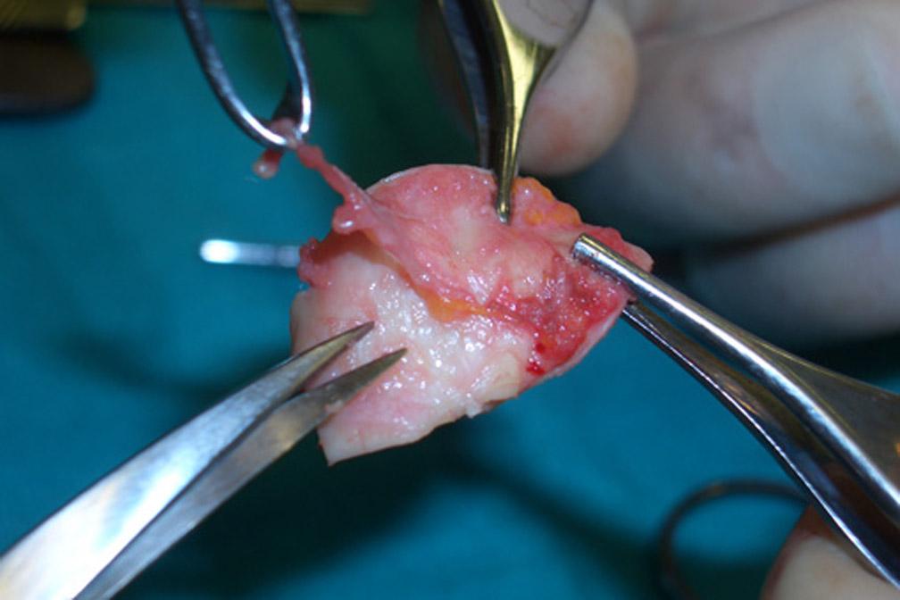 The tissues above the concha are detached so as to avoid exposing the cartilage completely and leave the perichondrium attached to its posterior surface.