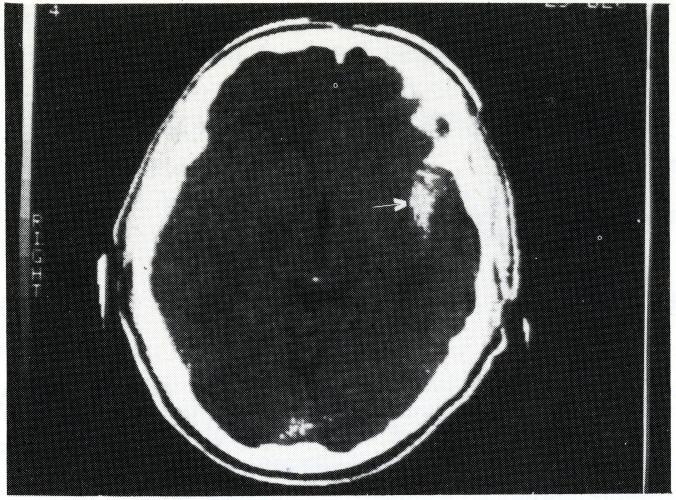 The diagnosis of subarachnoid hemorrhage should be confirmed as soon as possible by means of a computerized tomography (CT) scan, which frequently demonstrates the blood in the subarachnoid space
