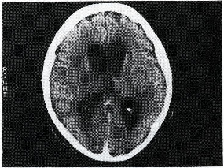 Finally, CT scanning might have value in determining the prognosis. Figure 1. CT scan in patient with ruptured middle cerebral artery aneurysm (arrow indicates blood within the sylvian fissure).