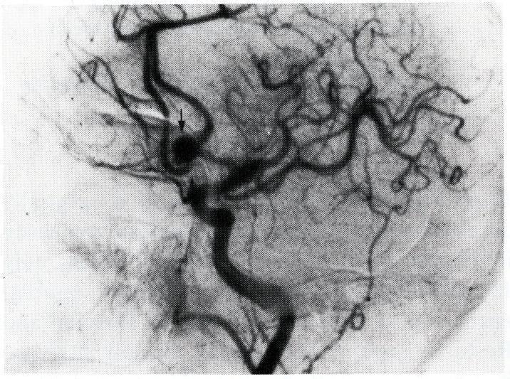 vessels, the parent vessel, and the presence of vasospasm are well delineated by selective angiography, and they are critical factors in the planning of surgical attack.