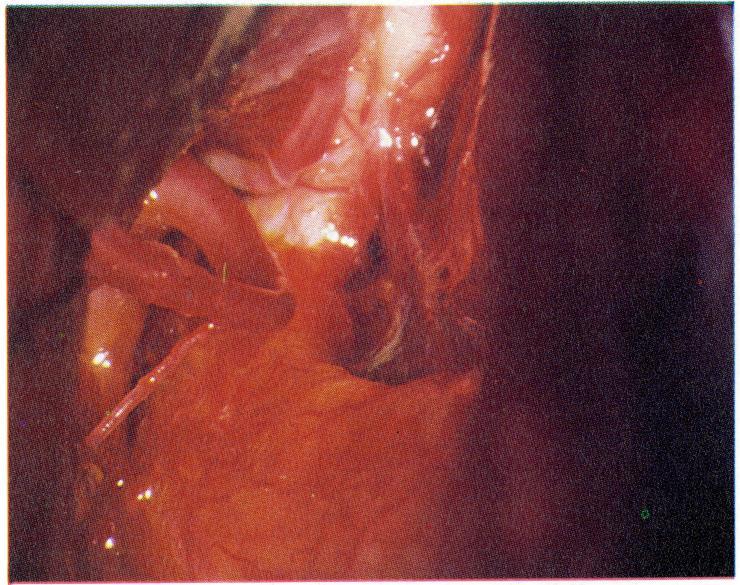 Exposure of anterior communicating artery aneurysm.
