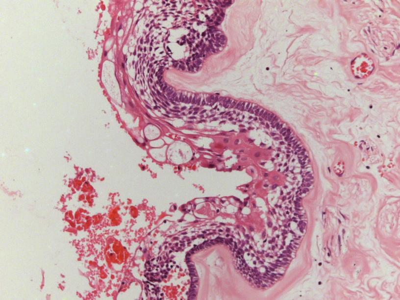 odontogenic epithelium (Figures 3 and 3). The final diagnosis established based on the association of clinical and microscopic features was of unicystic ameloblastoma with mural proliferation.