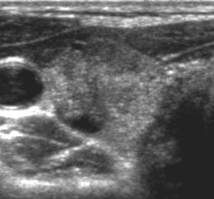 The two factors may have contributed to the low sampling error rate and influenced our results. Various ultrasonographic findings of malignant thyroid nodules or PTCs have been reported.
