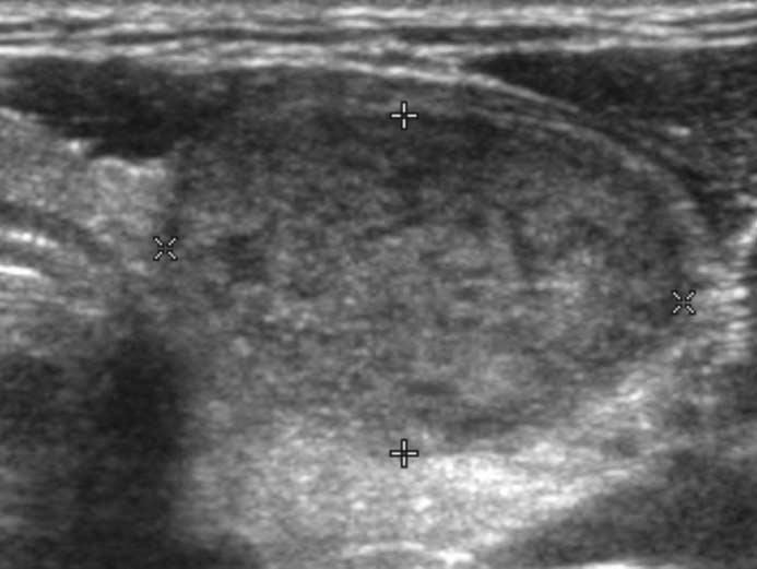 Prominent tumor component > 30% and no fibrosis are seen on histopathologic image (A). These findings are characterized as heterogeneous echotexture and hypoechoic echogenicity on ultrasonography.