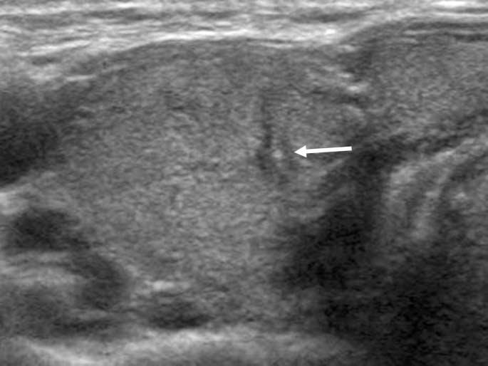 the use of an US-FNAB for thyroid nodules smaller than 10 mm in diameter. Nam-Goong et al.