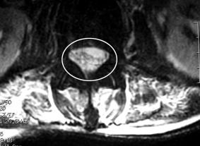 50 Hong Kong j. emerg. med. Vol. 10(1) Jan 2003 bifemoral prosthetic graft was well incorporated into the retroperitoneal tissue. MRI of the spine was done which showed epidural abscess from T3 to L5.